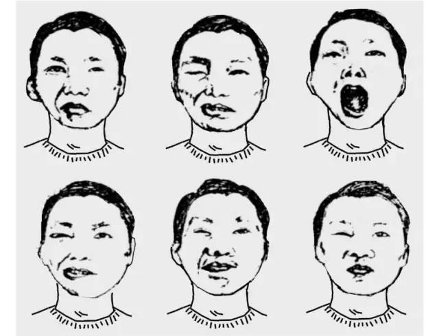 如何拯救面瘫脸无表情,如何才能拯救我的脸