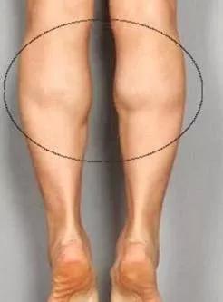 女性锻炼成肌肉小腿后怎样瘦小腿,小腿肌肉多怎么瘦小腿