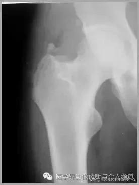 软组织钙化是不是骨化性肌炎,软组织钙化或骨化