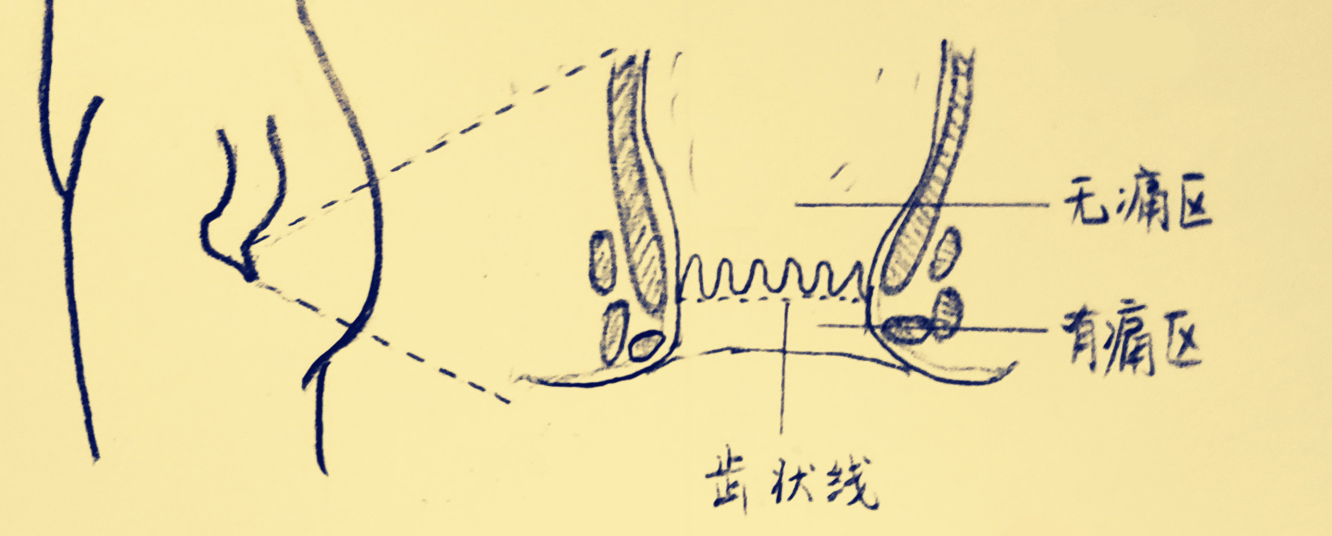 最近屁股有点痛是长痔疮了吗,腚疼严重会不会得痔疮