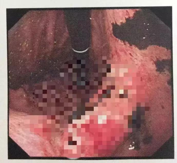 太任性！火车上连吃5包辣条致腹泻，原因：男友发微信给前女友