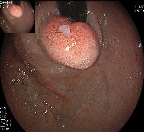 贲门处见隆起性病变,贲门高级别瘤变esd术后不能吃什么
