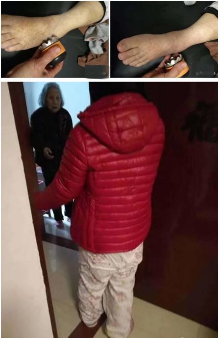 脚踝扭伤消肿散瘀针灸拔罐,脚扭伤消肿散瘀可以用拔火罐吗