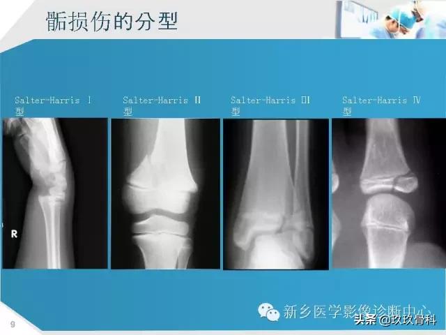 骨骺损伤x线表现,骨骺损伤磁共振表现