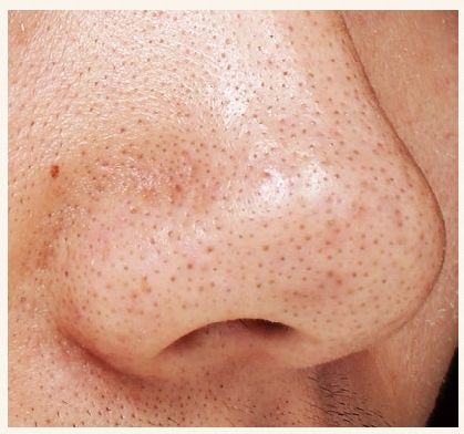 去黑头简单粗暴,去黑头不入坑