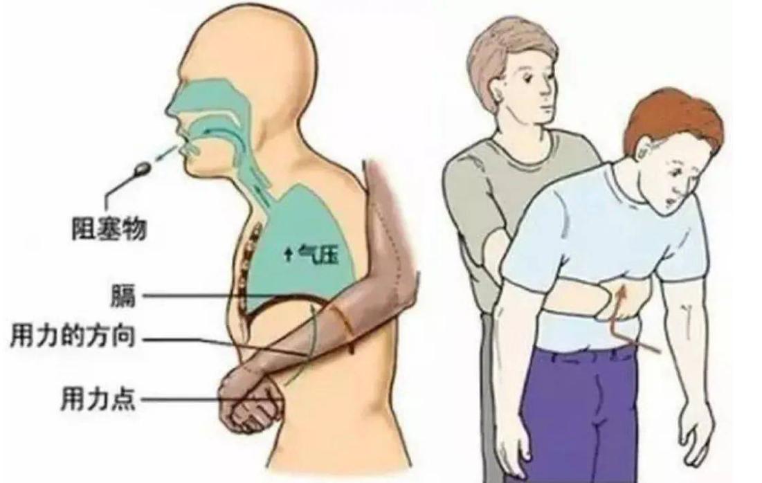 一岁宝宝呛着海姆立克急救,1岁以下婴儿呛奶海姆立克急救法