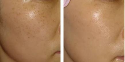 国际上有根除遗传雀斑的方法吗,专业祛斑四天根除遗传性雀斑