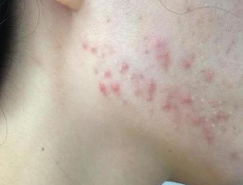 下巴反复长痘痘的原因和解决方法,下巴老是长痘痘怎么调理身体啊