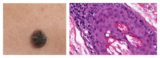 老年人脸上有小黑痣是怎么回事,老年人脸上黑痣越来越大