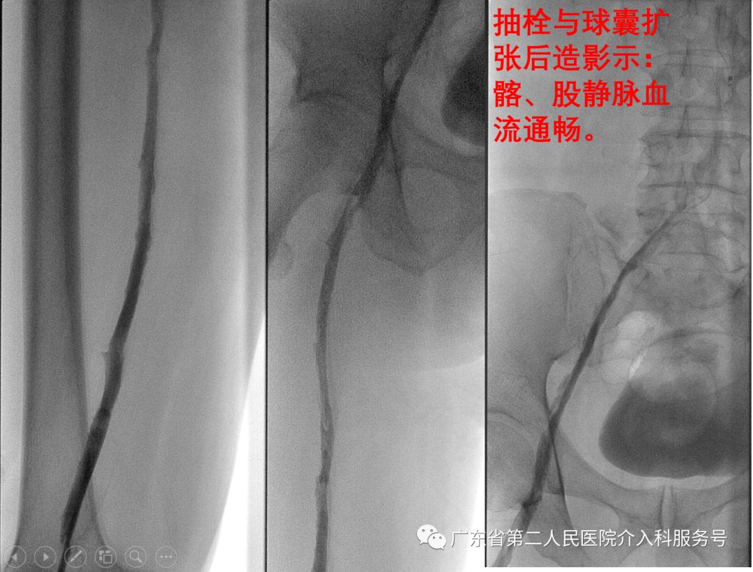 左腿血栓的最快消除方法,左腿浮肿有血栓用什么药治疗
