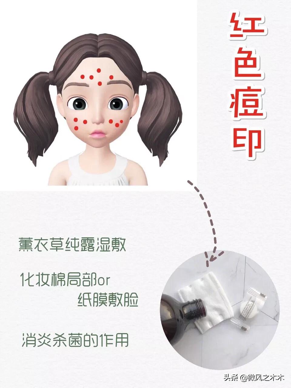 痘印痘坑消除要做多少次医美,去痘印痘坑痘疤的医美方法