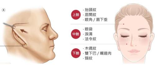 42岁做拉皮还是线雕,做线雕一年后可以做拉皮术吗
