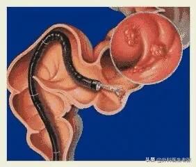 肛肠科医生检查痔疮多少钱,直肠癌免费检查