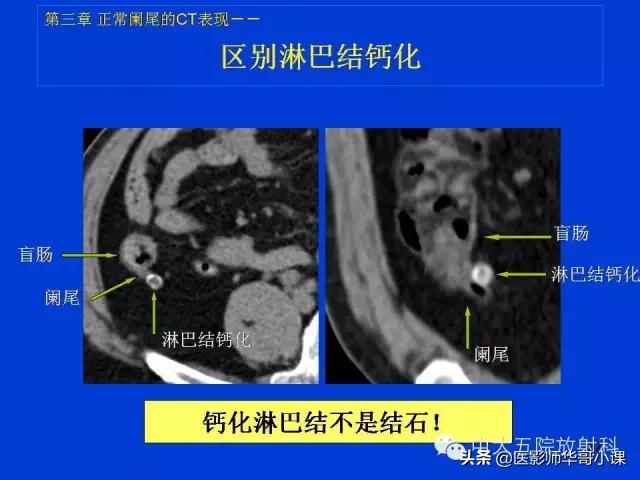 阑尾炎课件,阑尾炎的超声课件