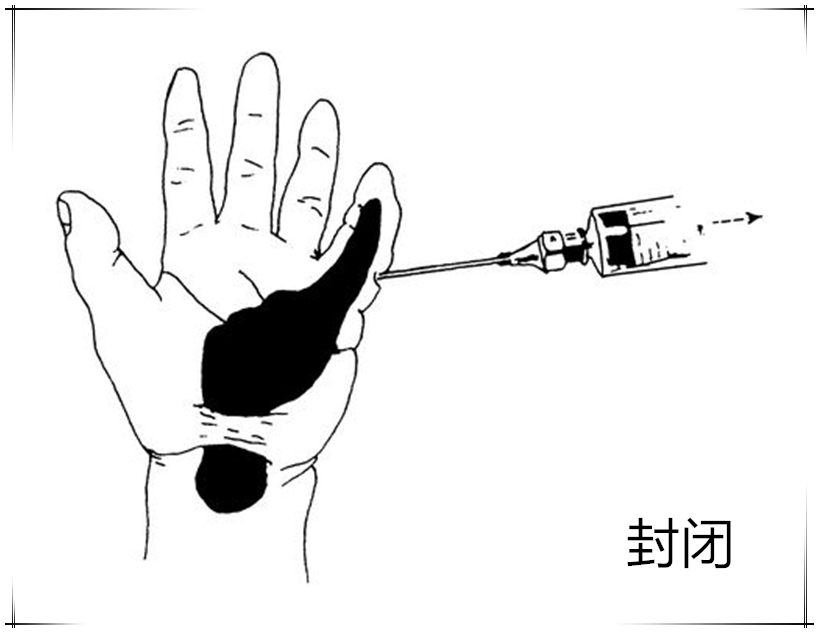 手指狭窄性腱鞘炎最快的恢复办法,手指狭窄性腱鞘炎怎么治疗小视频