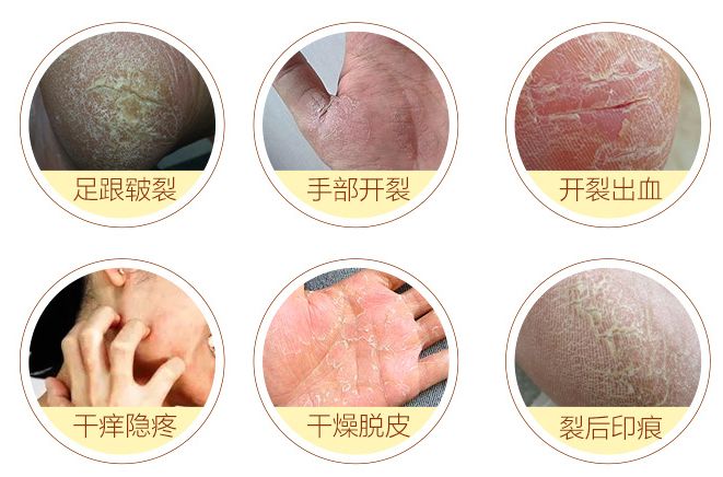 手脚干裂倒刺怎么治疗,手脚经常脱皮开裂最佳治疗方法