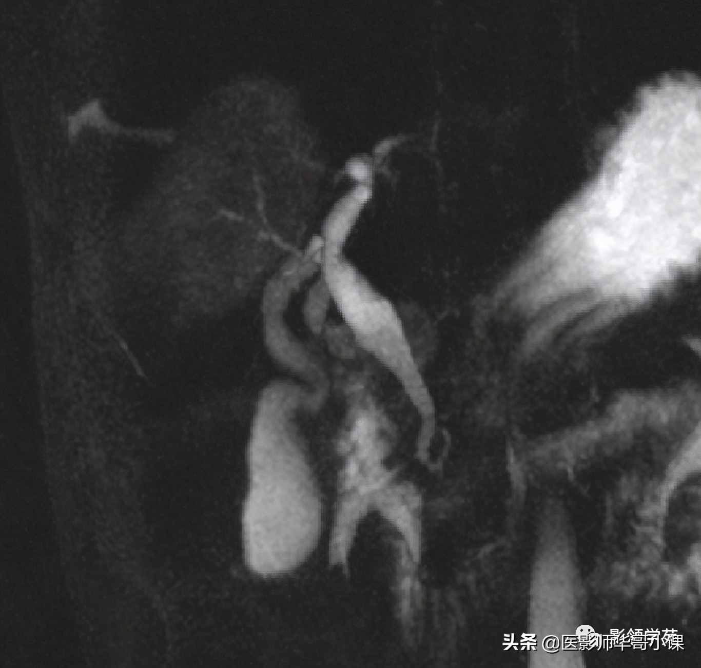 胆总管变异,胆胰管解剖