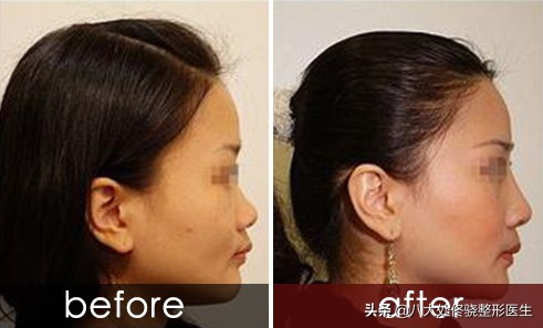 为什么注射玻尿酸会淤青,玻尿酸僵尸脸