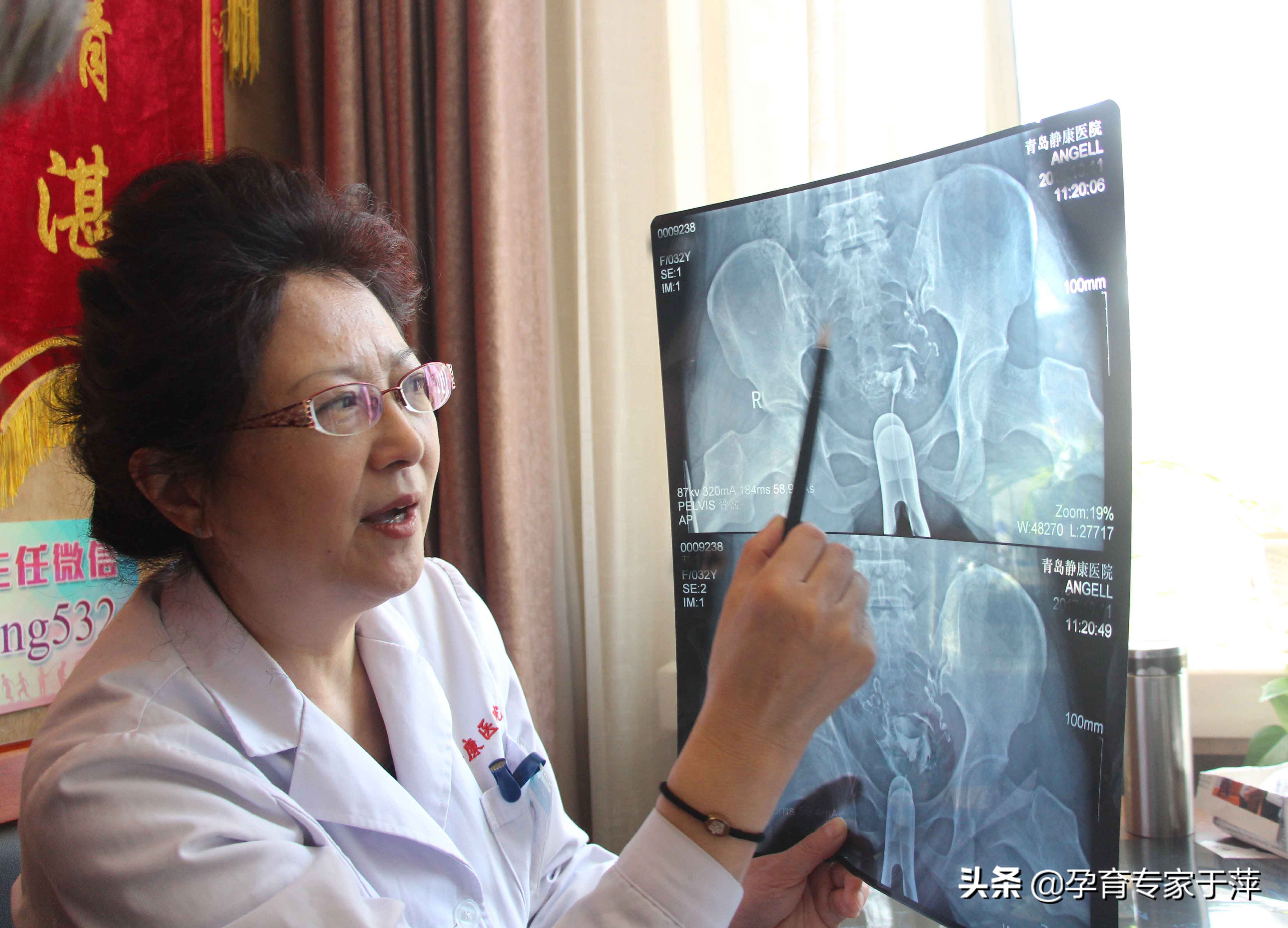 助孕专家于萍,青岛医生于萍视频