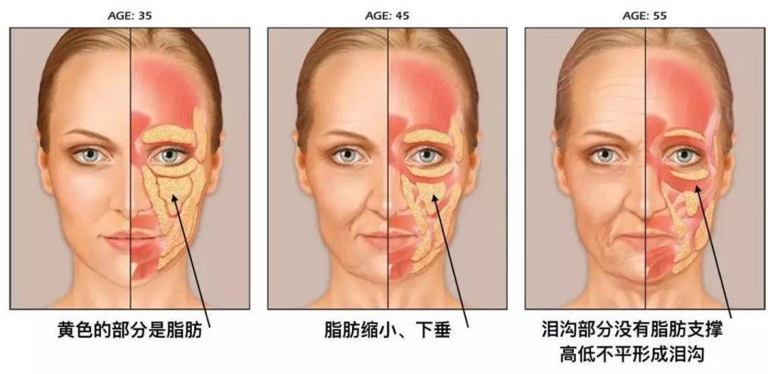 自体脂肪填充能去掉法令纹吗,去掉法令纹用什么护肤品好