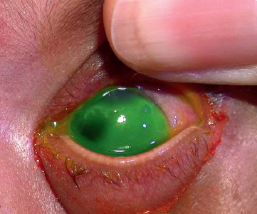 宝宝红眼病好的征兆,新生宝宝眼睛有点黄是怎么回事