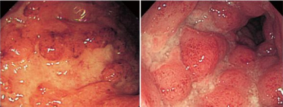 炎症性肠炎患者营养治疗,炎症性肠炎吃什么食物最好