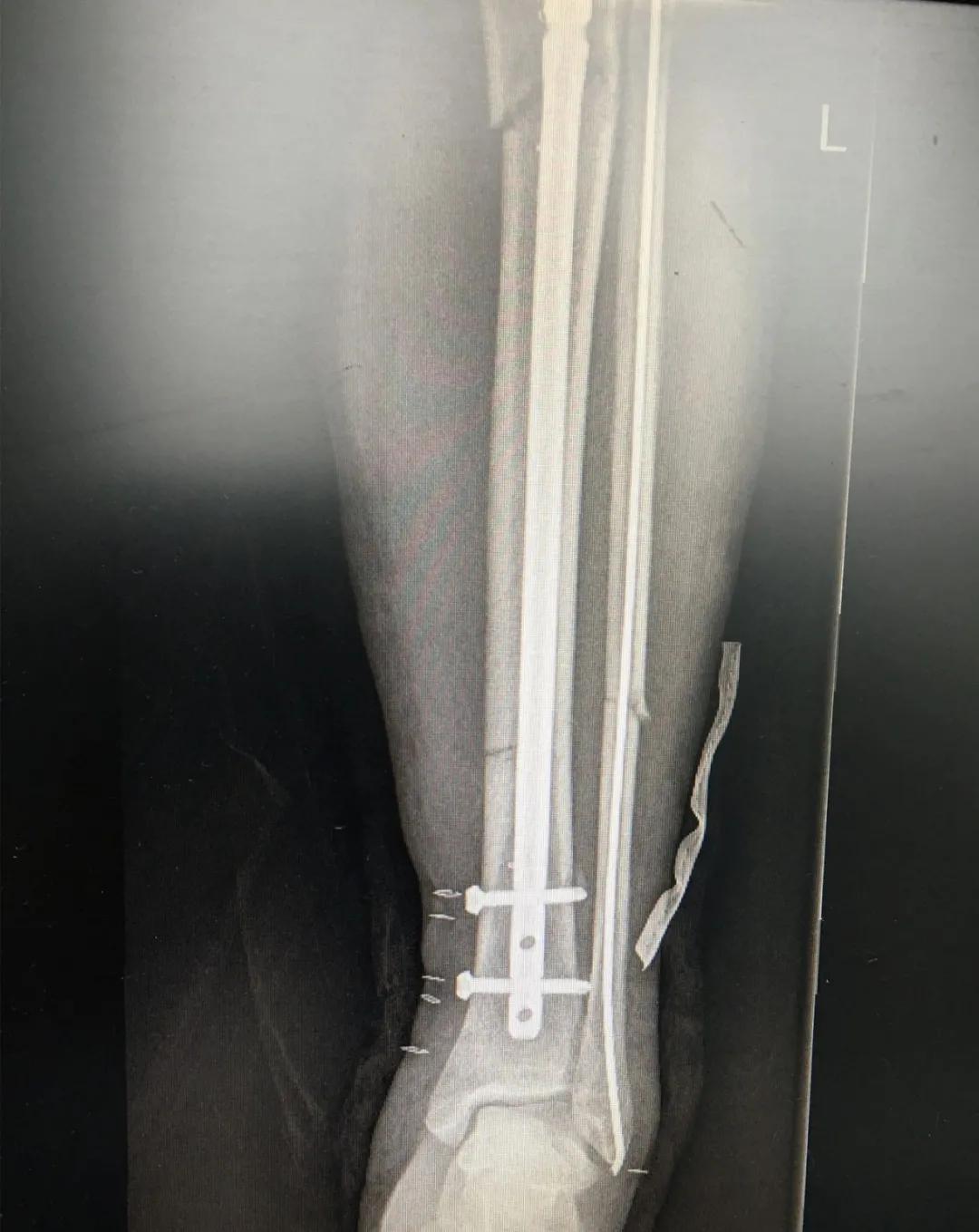 小腿骨断成三截了还能恢复吗,小腿断了三截能好彻底吗