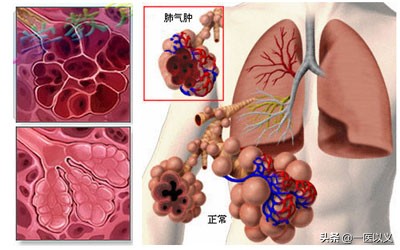 长期吸烟气管炎咳嗽咳痰,吸烟后会咳痰是怎么回事