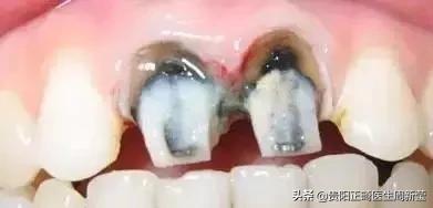 烤瓷牙十几年了有必要更换吗,烤瓷牙套里的牙烂了有什么症状