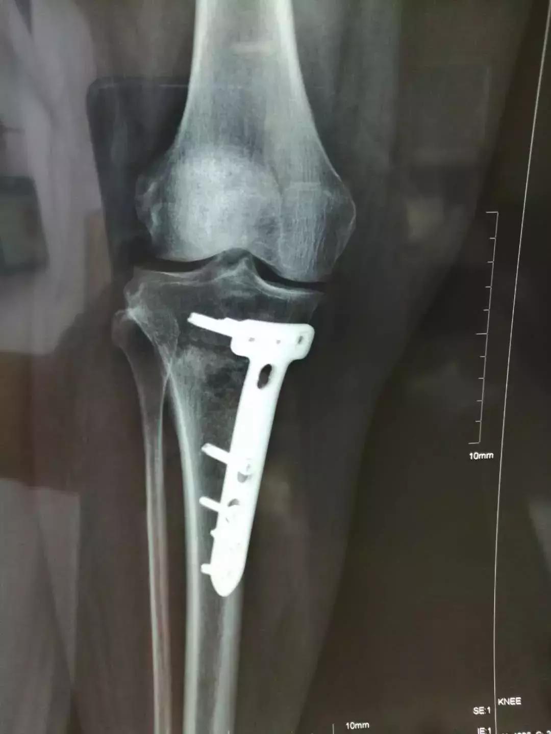 换膝盖关节手术有瘫痪风险吗,换膝手术可以百万医疗理赔吗