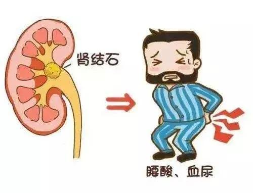 阜新治疗输尿管结石,肾盂大结石怎么处理最安全