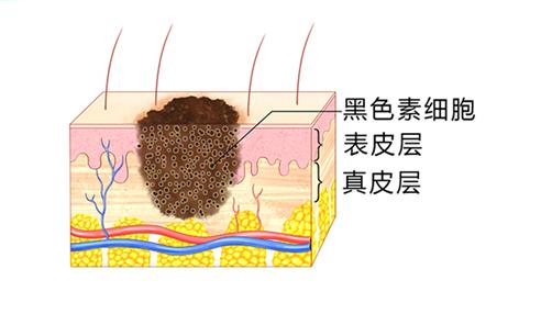 恶性黑色素瘤的靶向治疗进展,癌症基因治疗最新突破