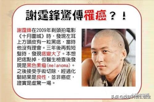 痣边缘模糊图片,痣长多大会变成黑色素瘤