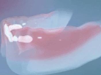 恒牙出来多久了乳牙未掉需要拔牙,孩子乳牙未掉用干预吗