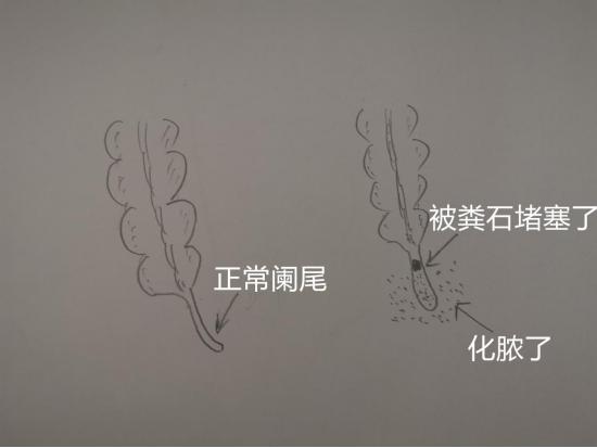 热血外科|Dr.Liu聊科普:阑尾炎究竟是何方妖孽？