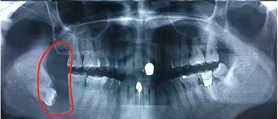 有没有智齿不拔的案例,我有个智齿没长出来怎么拔