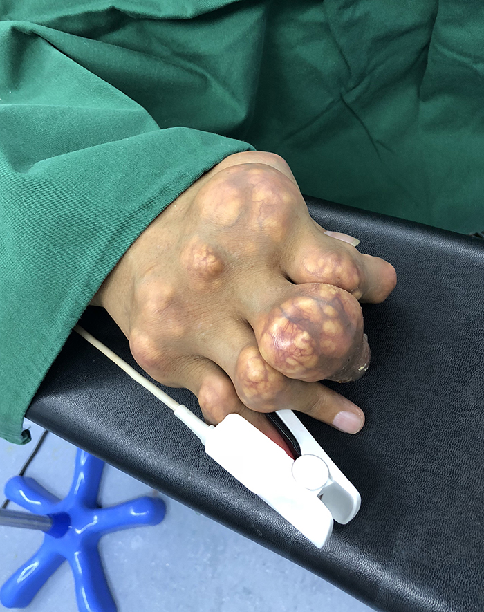 深圳哪家医院痛风石最好,正康骨科痛风