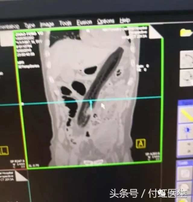 一条罗非鱼“游”进肛门?医生:直肠不直,进去容易出来难