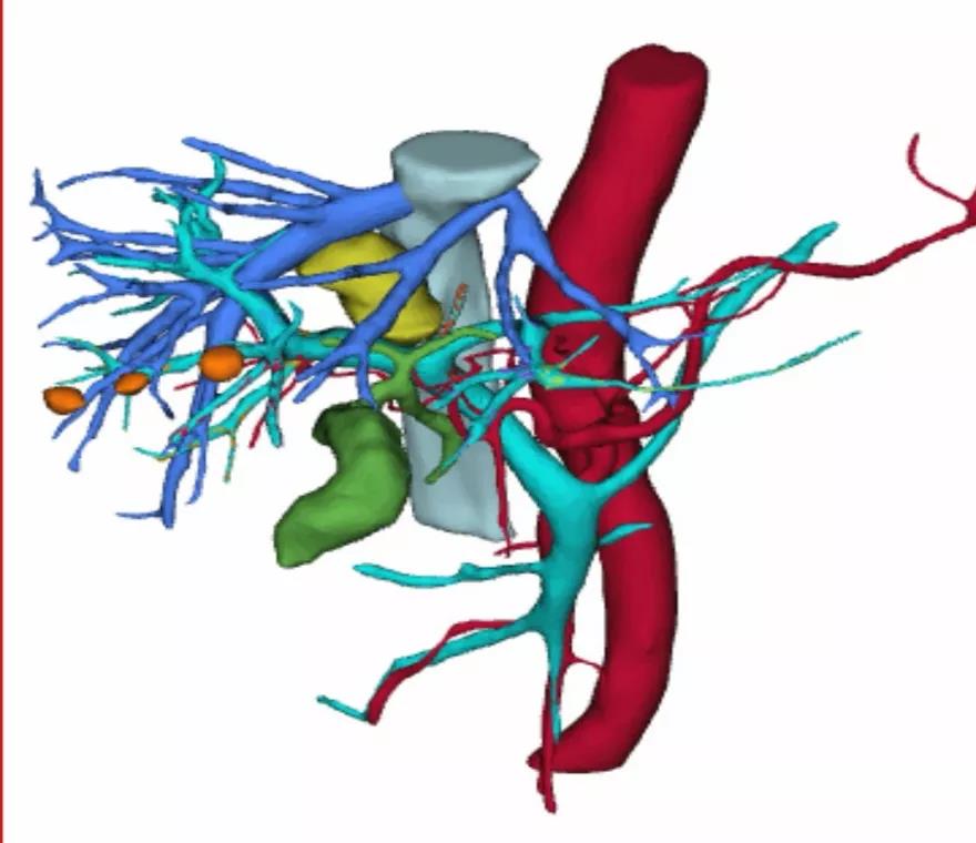 高龄老人肝癌晚期做介入治疗,72岁老人早期肝癌能手术吗