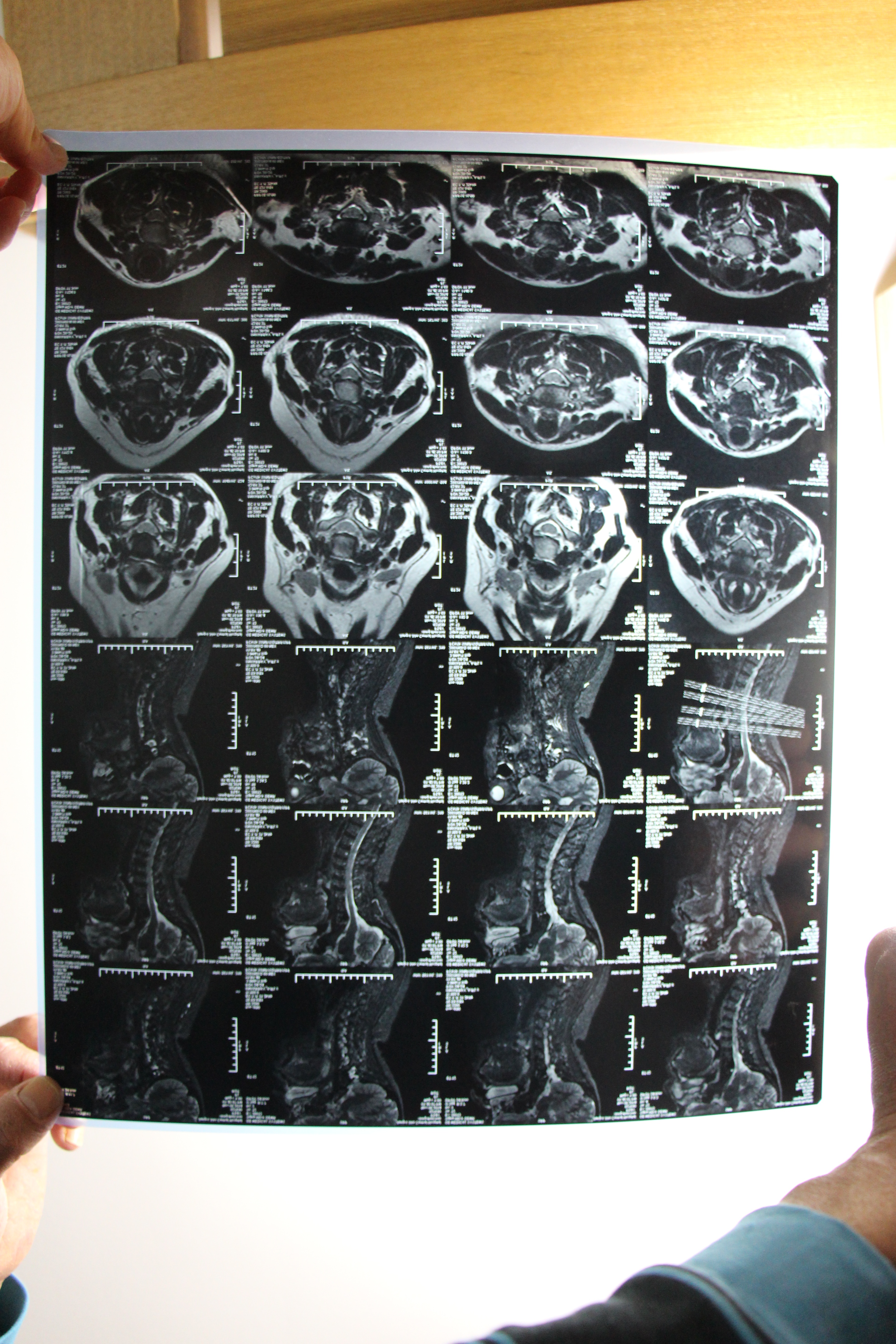 头晕站不稳四肢无力怎么回事,头晕站不稳害怕晕倒是什么原因