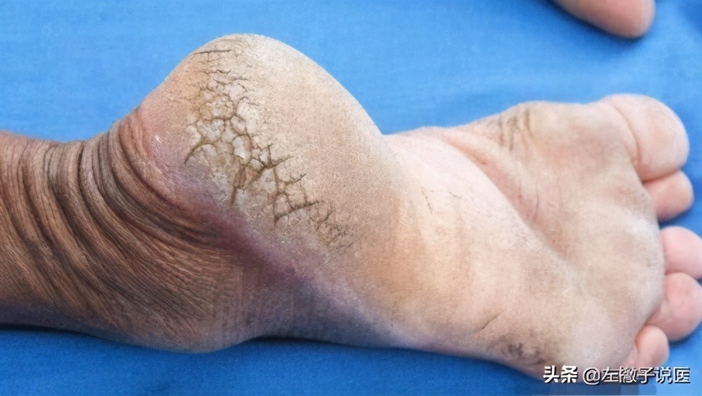 冬天一到脚后跟开裂,老年人冬天脚后跟开裂怎么办