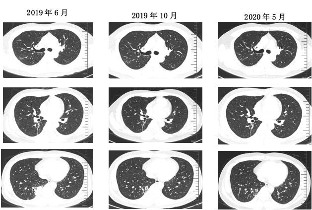 肺部陈旧病灶会变大么,肺部病灶1.2厘米严重吗
