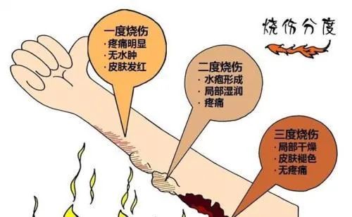 在野外开水烫伤了怎么急救,开水烫伤最好的急救办法