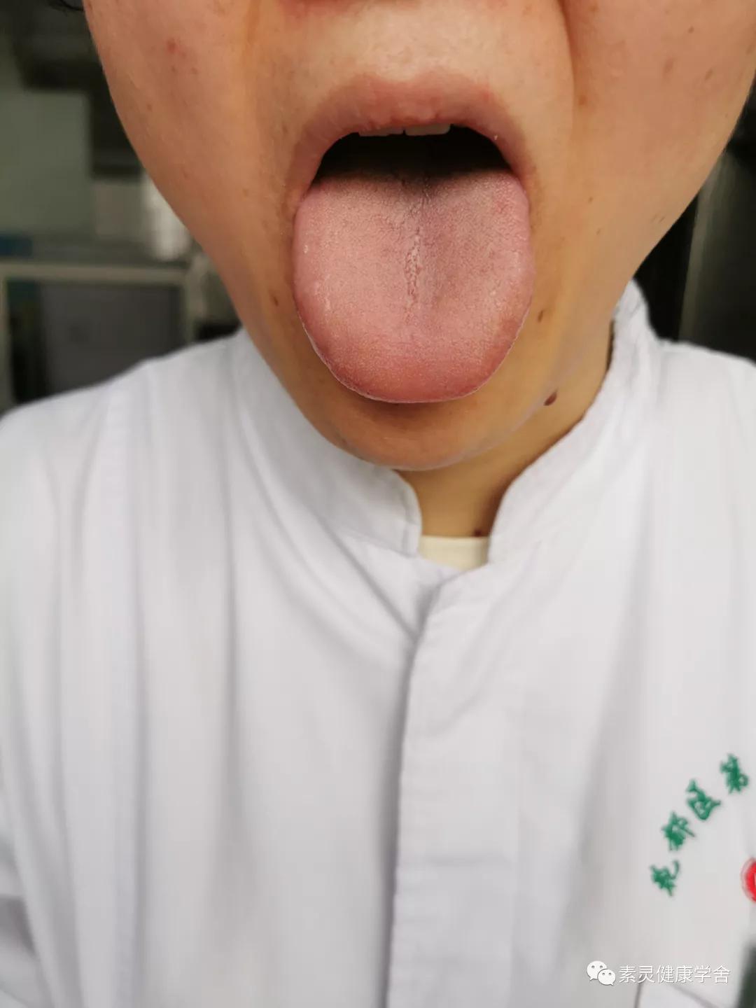 肝功异常的针灸穴位,脐疗绝密配方肝病