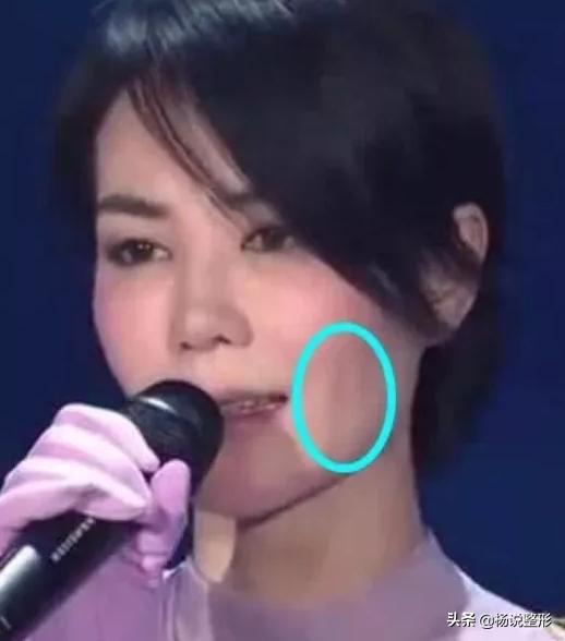 28岁做线雕提升脸部好不好,28岁女人做线雕现状