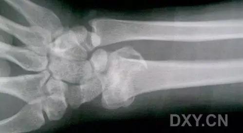 几种严重骨折医学名称,常见的骨折有哪些名称