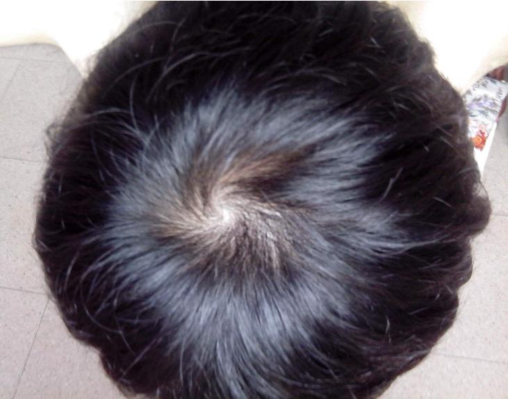 孩子的头旋长偏了是怎么回事,孩子的头旋是歪的