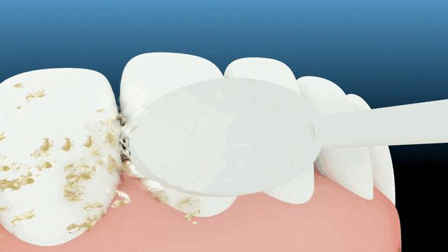 早晚刷牙了牙齿还是臭怎么回事,天天刷牙牙齿很黄很臭学会这一招