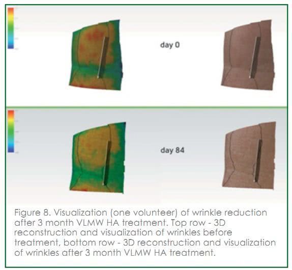 用胶原蛋白抗衰老抗皱纹面膜好吗,用玻尿酸面膜副作用有哪些