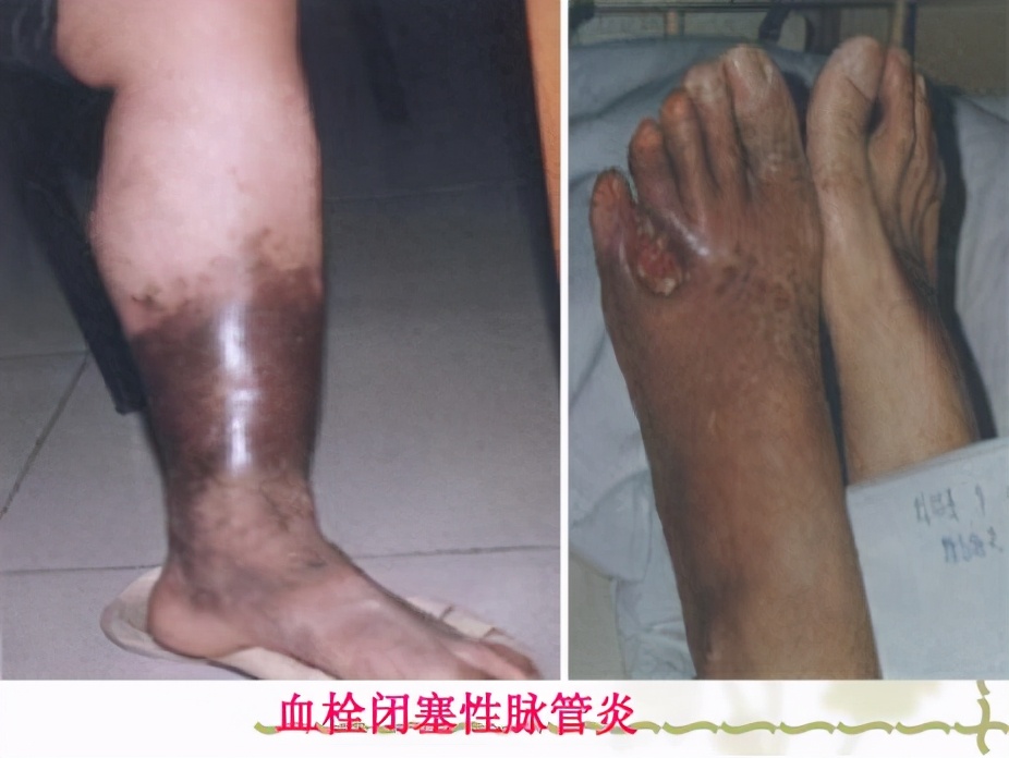 血管外科静脉曲张治疗,静脉曲张引起血管瘤如何治疗